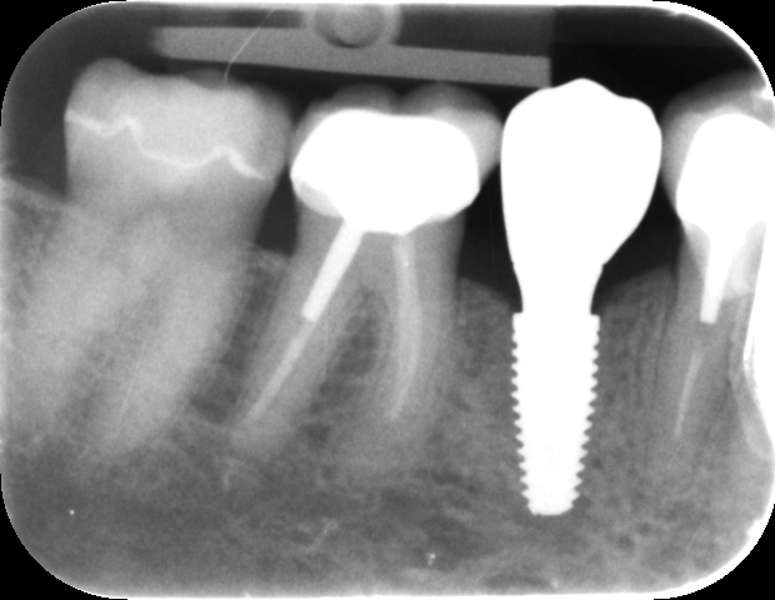 Fig. 7: Couronne unitaire définitive mise en place – aspect radiographique.