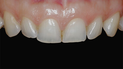 Fig. 1. Fotografía inicial de los dientes anteriores antes del tratamiento de ortodoncia.