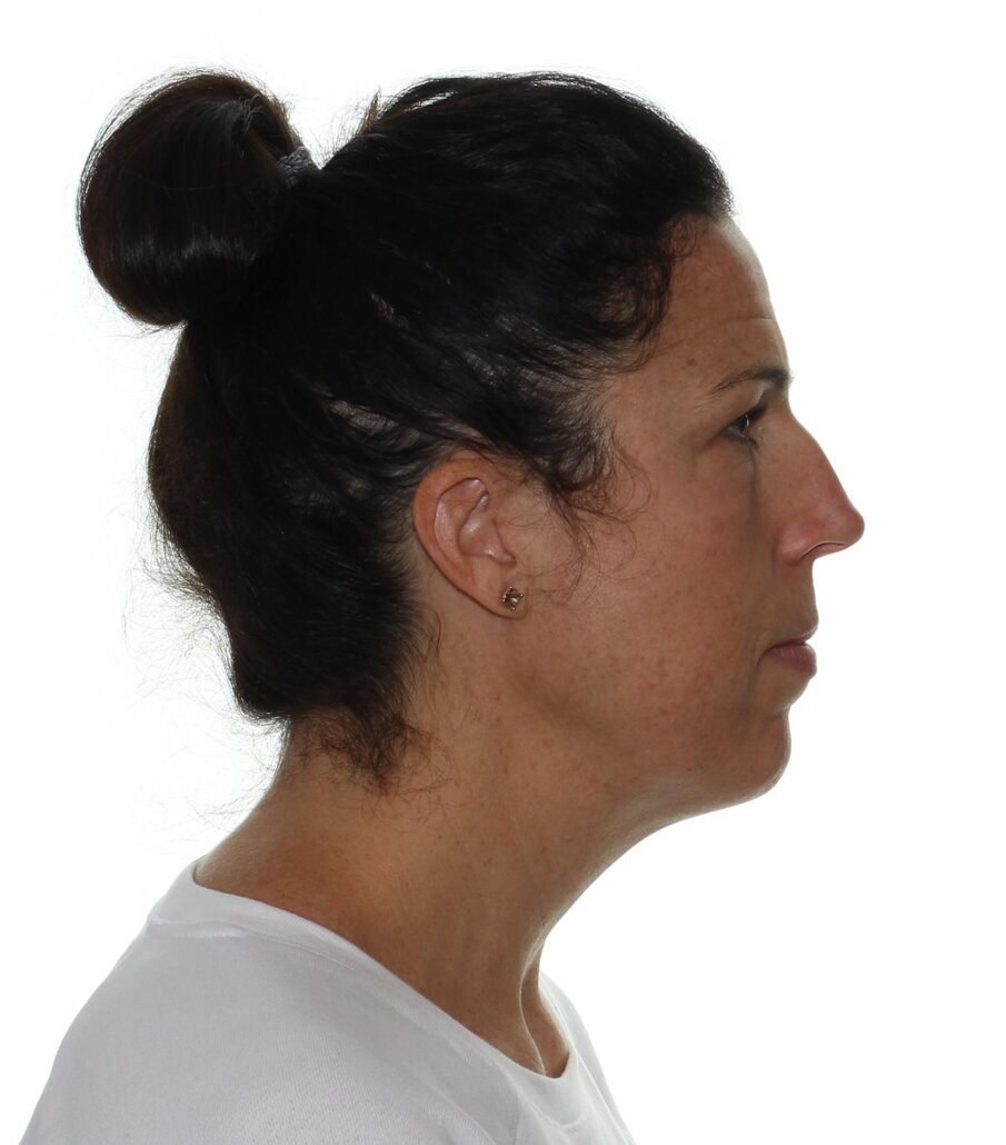 Pre-treatment