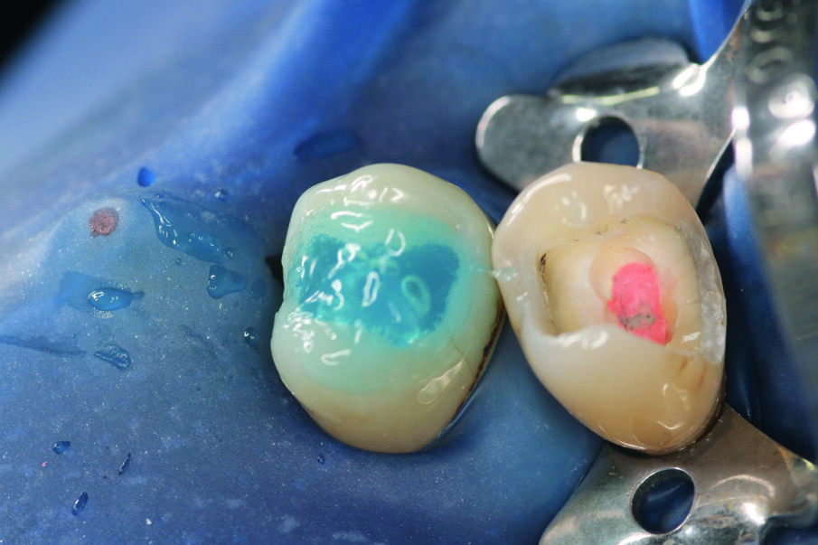 Fig: 3. Etching procedure with phosphoric acid gel (DeTrey® Conditioner 36).