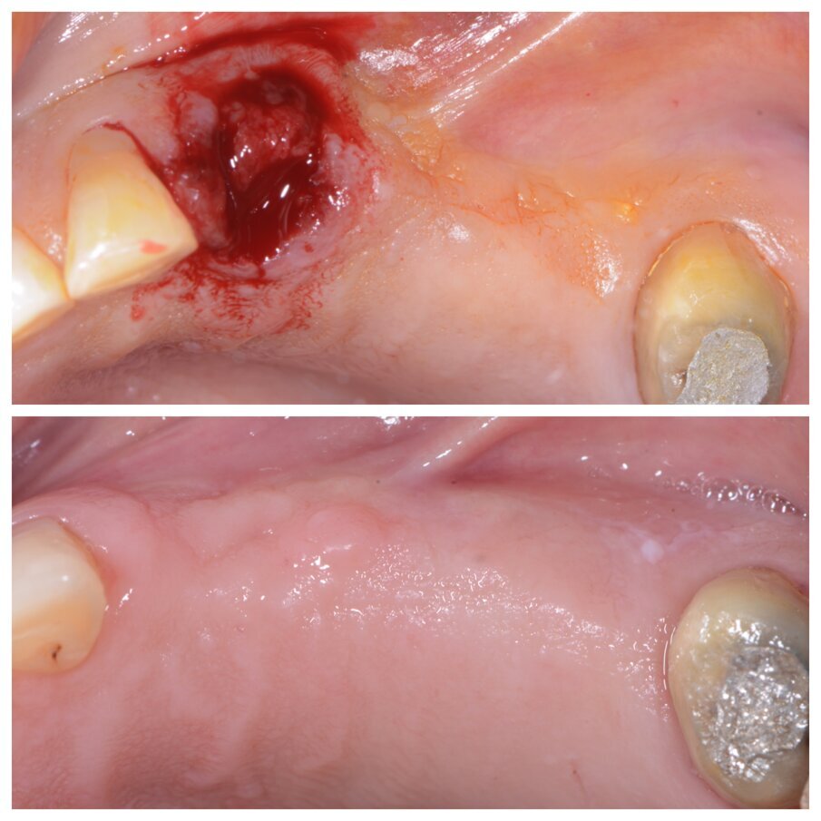 Fig. 2b_Guarigione dei tessuti a 6 mesi.