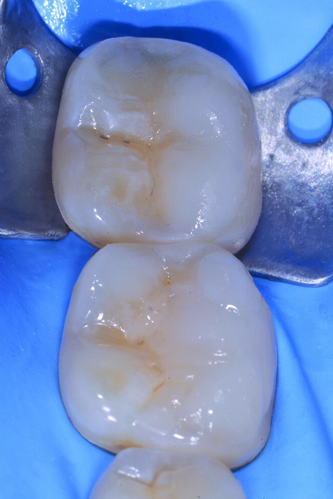 Figg. 2-5_Rimozione dei vecchi restauri presenti su 4.6 e 4.7: gli elementi vengono restaurati con tecnica diretta utilizzando dentina e smalto Enamel Plus HRI Bio Function. 