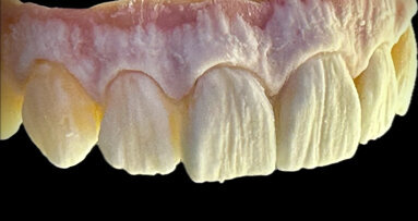 Micro-layering: A great concept for zirconia-based screw-retained implant-supported prostheses