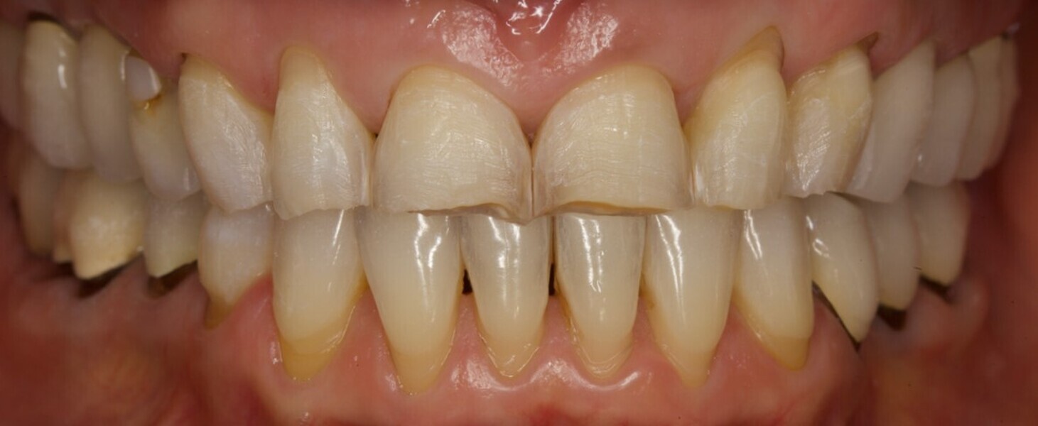 Fig. 9: Roughened tooth surfaces.