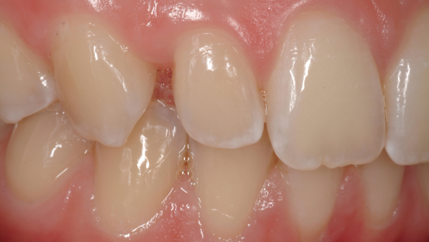 ‘No-Prep’ adhesive restorations: another way to deal with aesthetic deficiencies