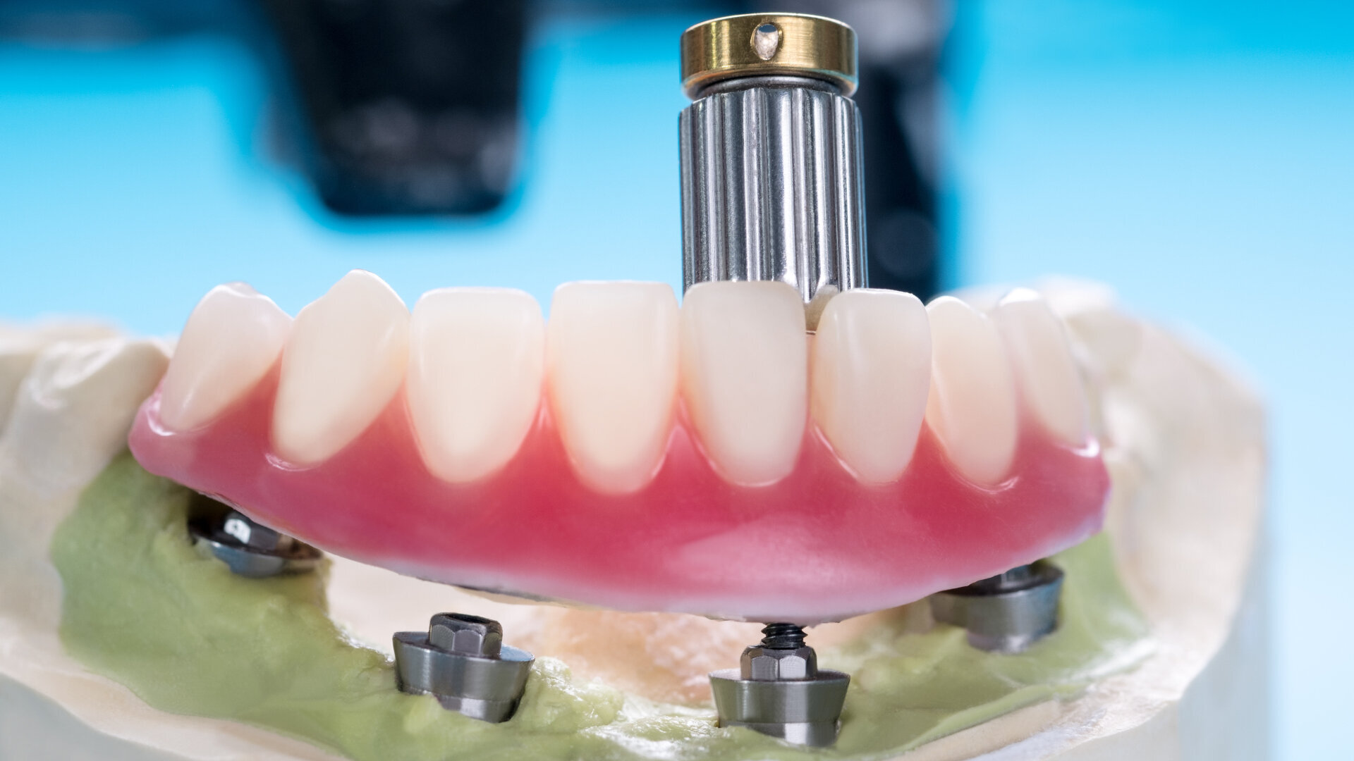 Trends in the US overdenture market