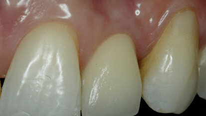 New grafting procedure for oral implantation