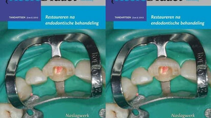 Veelbelovende aanpak bij restaureren na endodontie