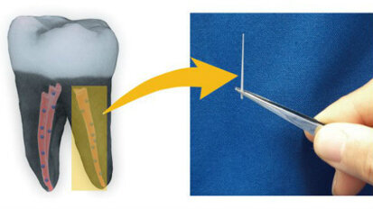 Sperimentati dagli scienziati nuovi biomateriali a base di “microdiamanti” per la terapia canalare