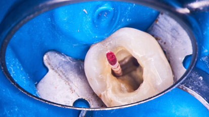 Řešení endodontických selhání
