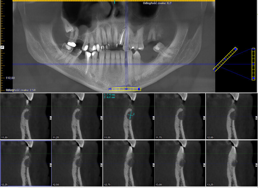Ryc. 1: CBCT wykonane przed leczeniem.