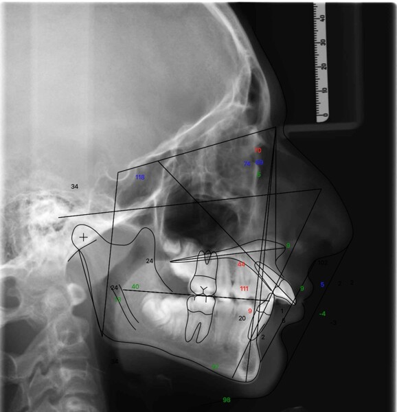 Fig. 4: Pretreatment cephalometric tracing superimposed on the lateral cephalogram.