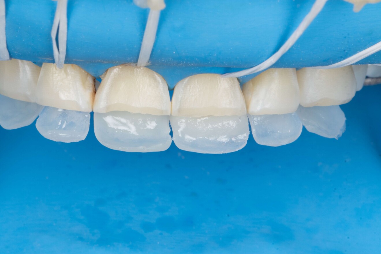 Figg. 5a–c: Tecnica bilaminare utilizzata per i restauri anteriori sotto isolamento con diga di gomma. Strato iniziale e strato di dentina realizzati con G-ænial A’CHORD (a & b). Restauri anteriori completati dopo l’applicazione dello strato finale di smalto con G-ænial Universal Injectable (c).