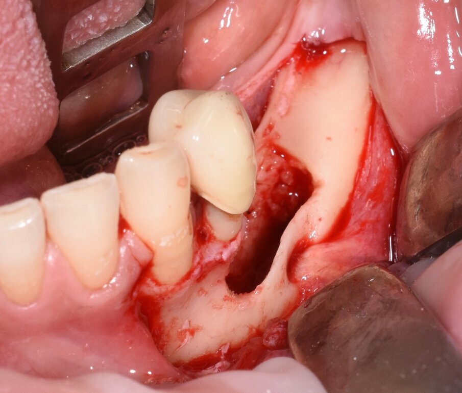Fig. 10 - Cavità alveolare residua che evidenzia l’integrità del nervo mentoniero.