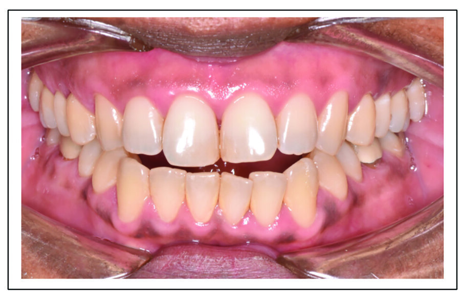 Fig. 13a. Patient S. P. pre-treatment.