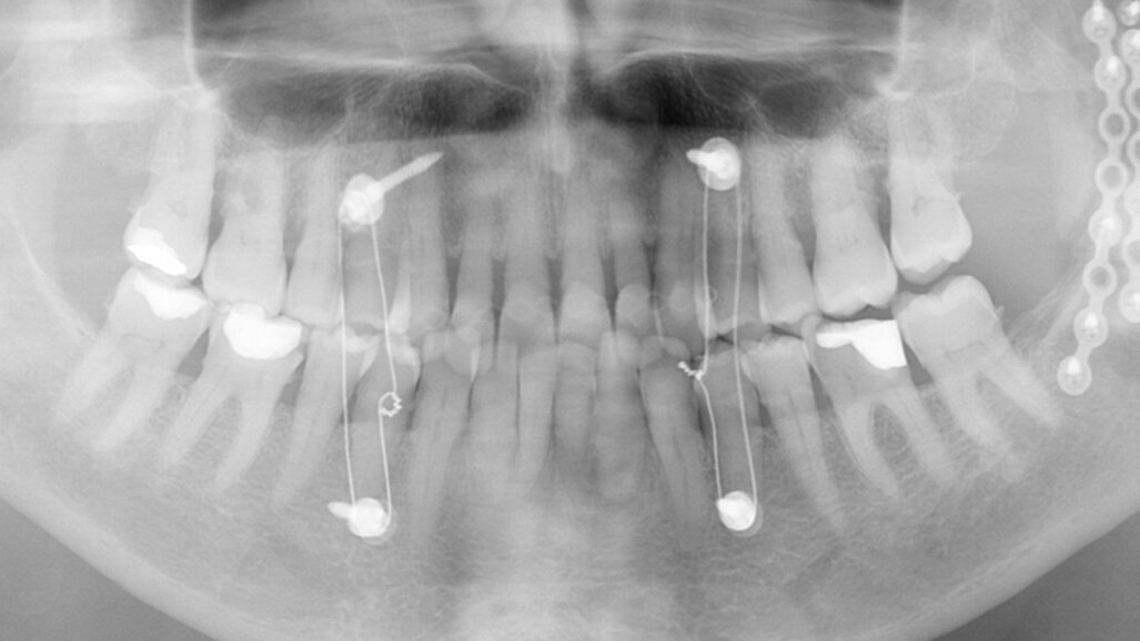 Unilateral occlusal elevation with a lithium disilicate onlay and a zirconia bridge