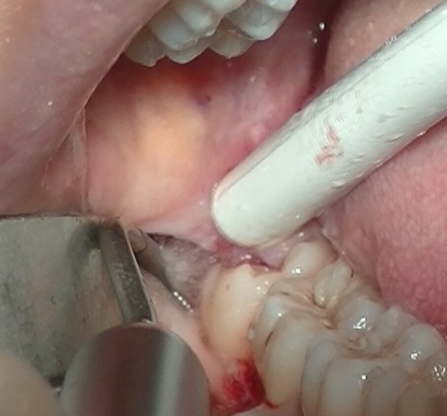 Fig. 6 - Gli inserti MICRO-SAW con uno spessore di soli 0.25 mm vengono efficacemente impiegati nell’estrazione di elementi dentari inclusi, garantendo osteotomie rapide e precise.