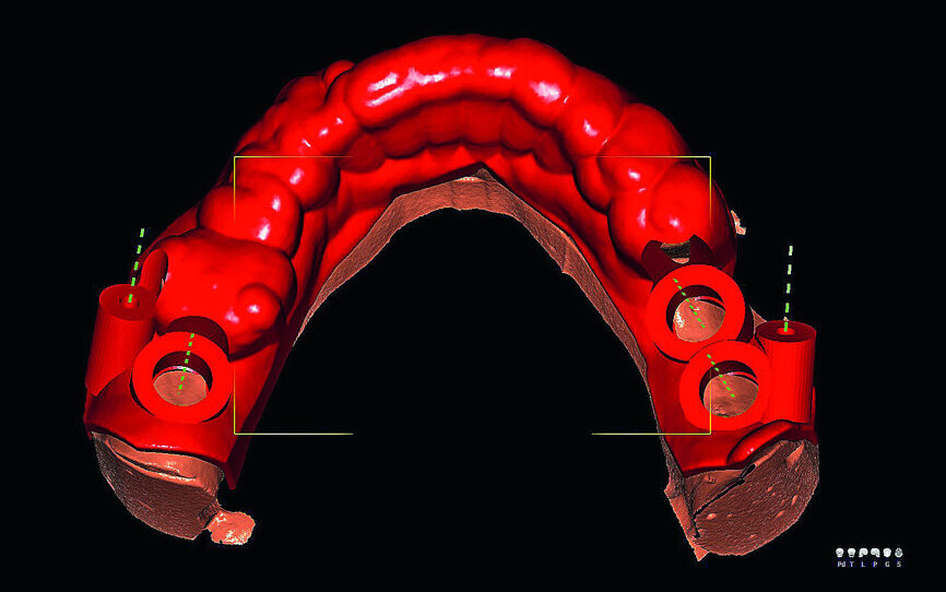 Fig. 1b: Virtual planning of implant positioning.