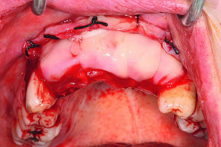 Fig. 9: The properly compressed PRF membranes permitted complete coverage of the surgical site, in this instance on the maxilla.