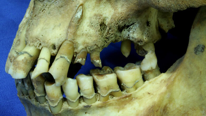 Les conséquences d’un important tabagisme sur la santé bucco-dentaire durant la famine en Irlande