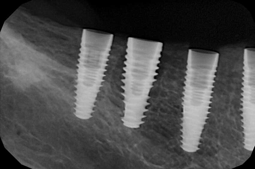Fig. 4 - Rx post-operatorio.