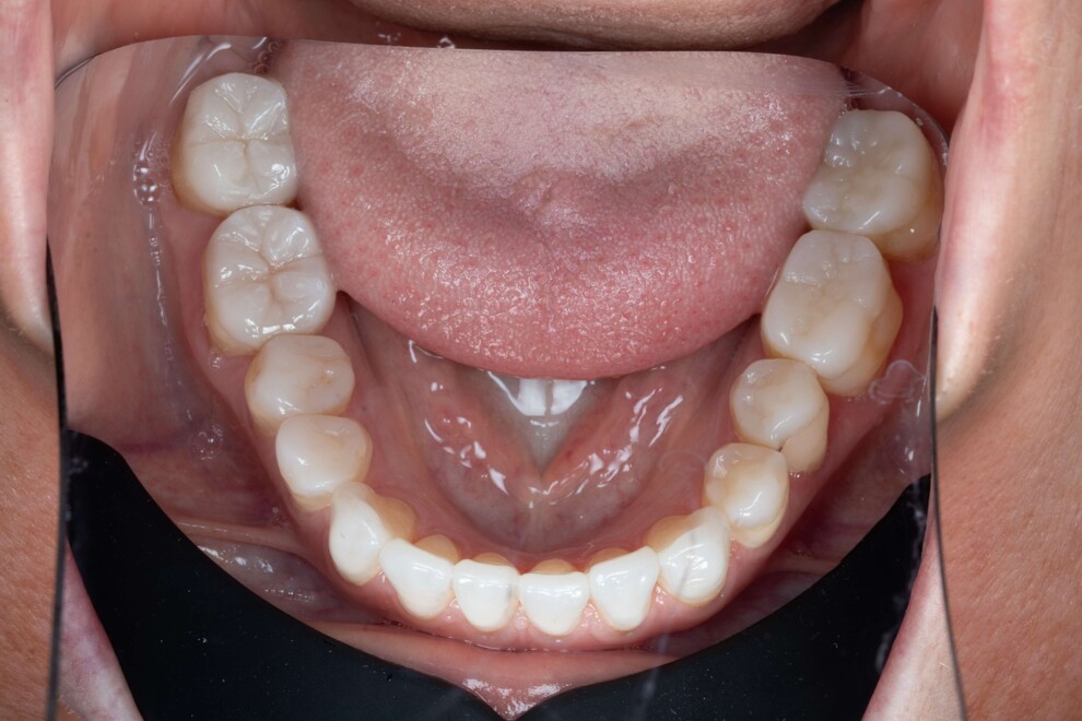 Fig. 7: Vista occlusale dell’arcata mandibolare dopo il trattamento che mostra i restauri lucidati in Initial LiSi Press sul dente #46 e sul dente #47.