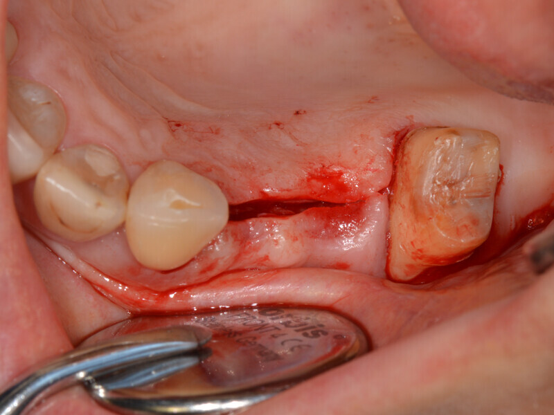 Fig. 8: After the mid-crestal incision before raising the mucoperiosteal flap.