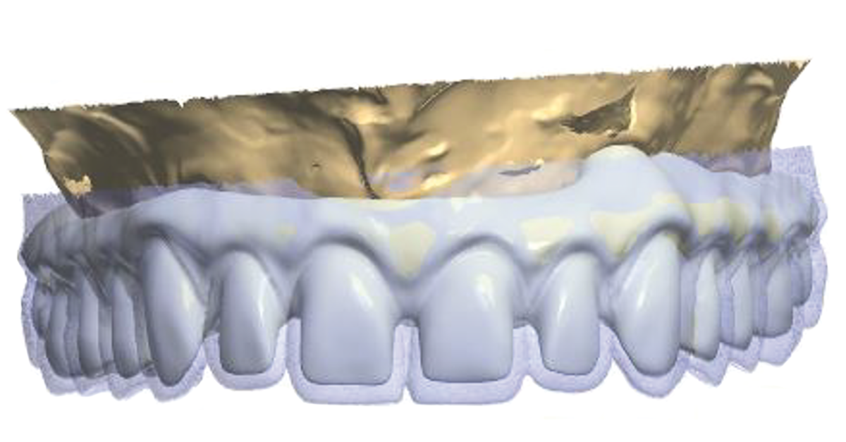 Dental News - The use of CBCT and CAD/CAM techniques in complex implant ...