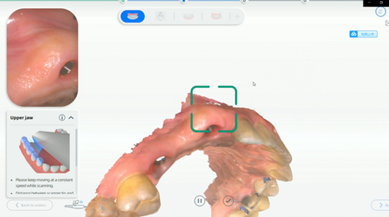 Figs. 2 & 3: Scan without the scan bodies attached.