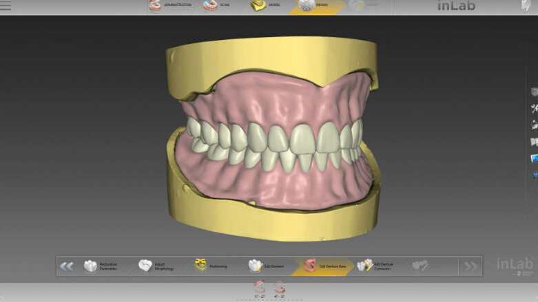 Protesi totale con inLab Software 20.0 – Semplicemente digitale