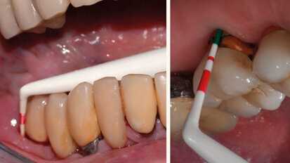 Mantenimento implantare:sondare o no?