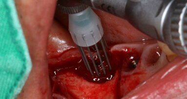 Une nouvelle procédure chirurgicale peut aider à combattre la péri-implantite