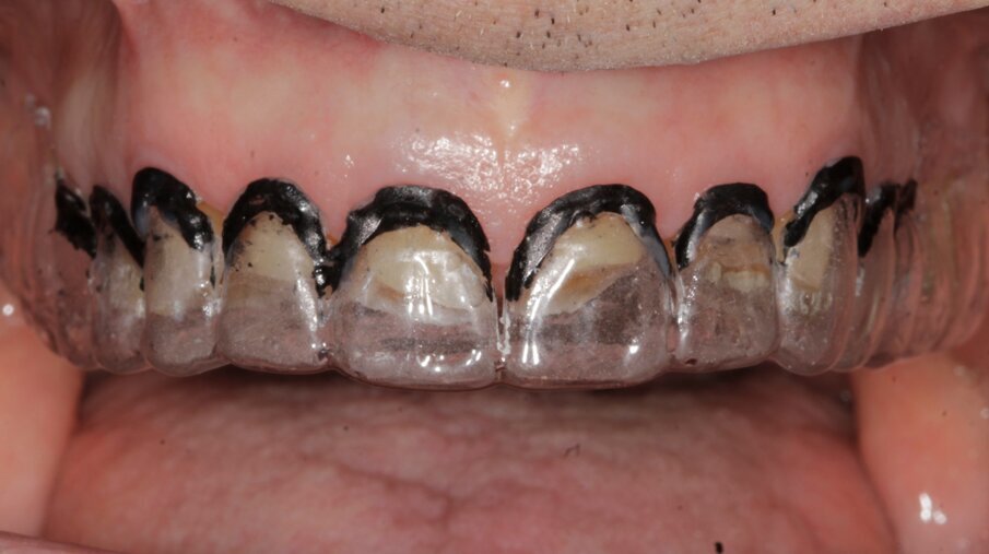 Fig. 4: Vacuum-formed tray prepared from the wax-up as guide for surgical crown lengthening procedure