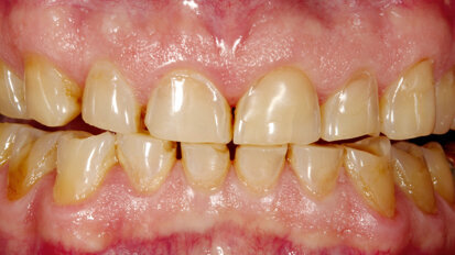 Full-mouth restoration with Zolid&nbsp;FX— a successful concept for sophisticated prostheses