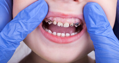 EFP reveals stunning global cost of gingivitis, caries, tooth loss