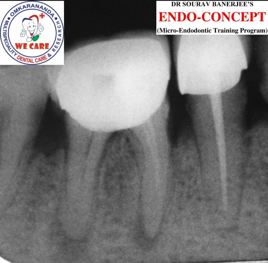 Fig.1a: Pre-op radiograph taken by the referring dentist.
