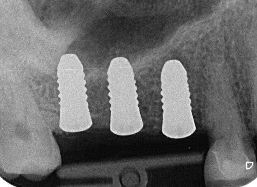 Fig. 17 : Radiographie de contrôle postopératoire. 