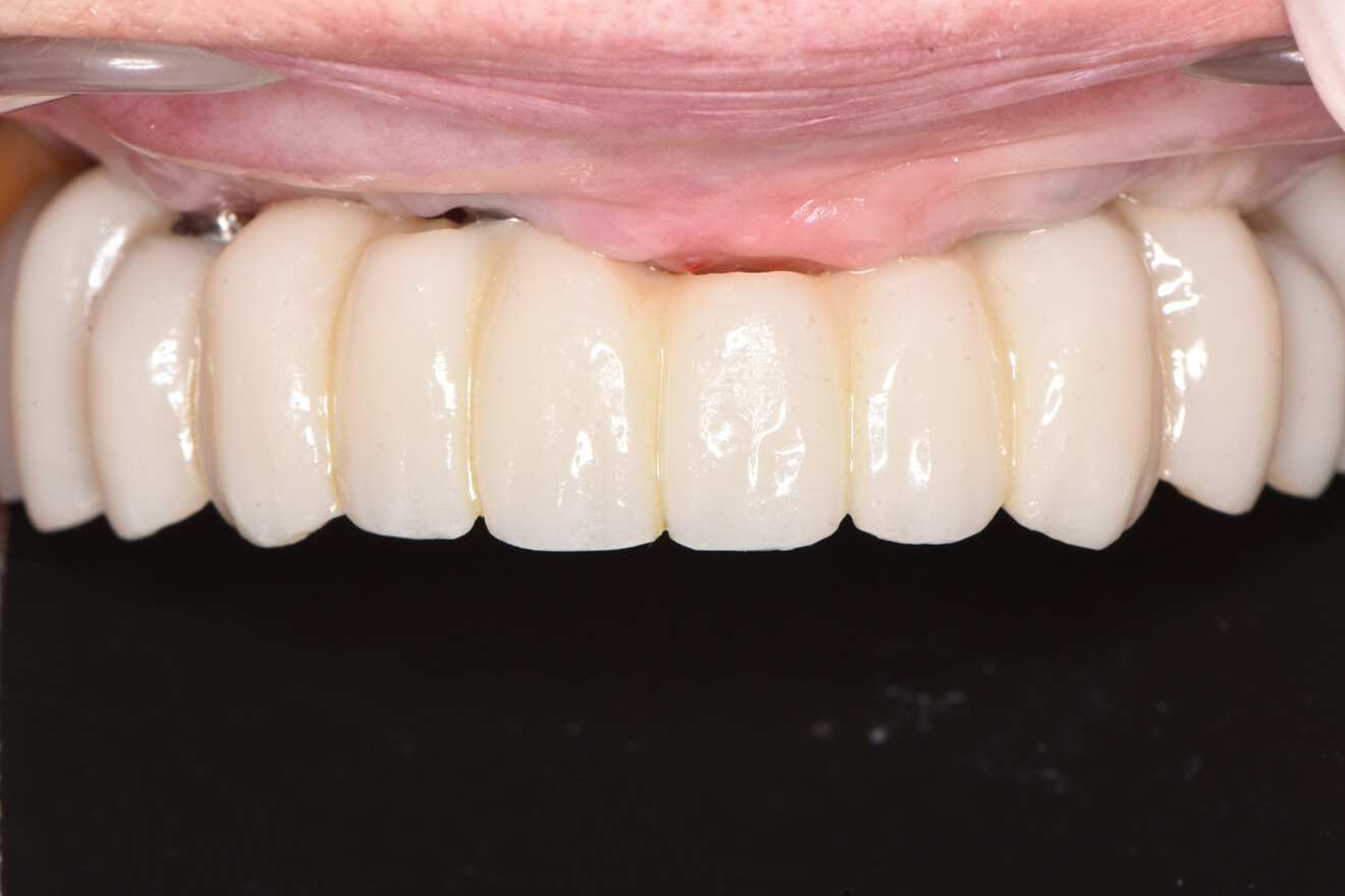 Fig. 5f: All-on-5 provisional restoration shown after intra-oral placement.