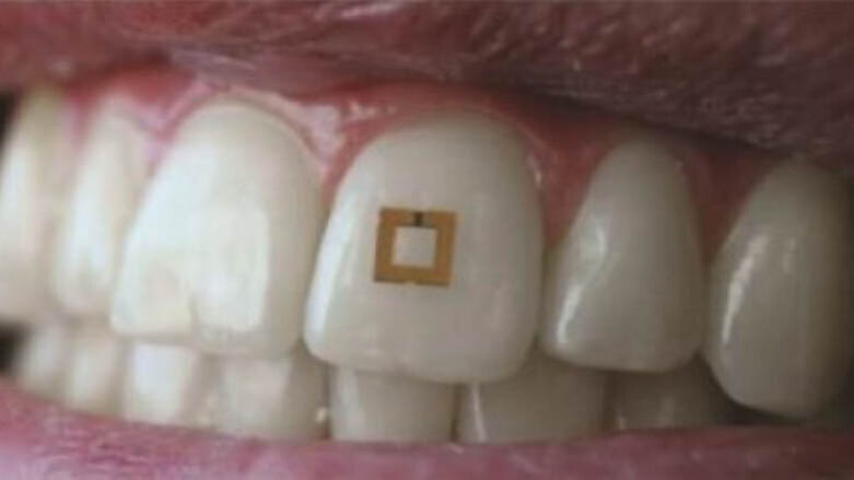 Un nouveau dispositif fixé sur les dents piste les aliments ingérés
