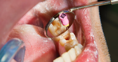 Selon une enquête de la FDI, les soins endodontiques spécialisés demeurent un défi