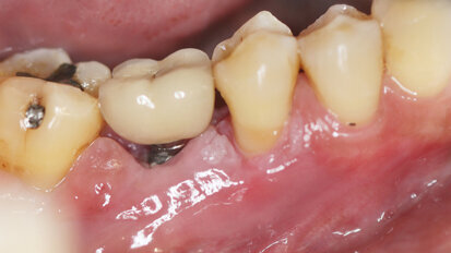 Peri-implantitis second most common complication following dental implant therapy