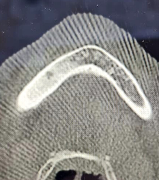 Fig. 8: Axial view of the CBCT scan showing a small apical infection of the mandibular right first molar, surrounded by an area of dense ossification extending over a large part of her mandible.