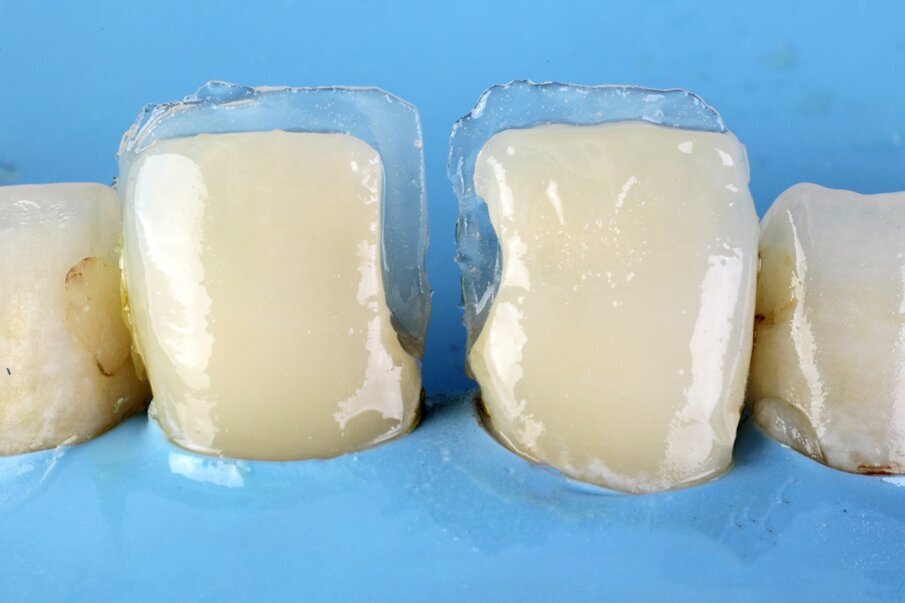 Fig. 6: Free hand palatal shell created with Beautifil II Enamel shade T (Translucent).