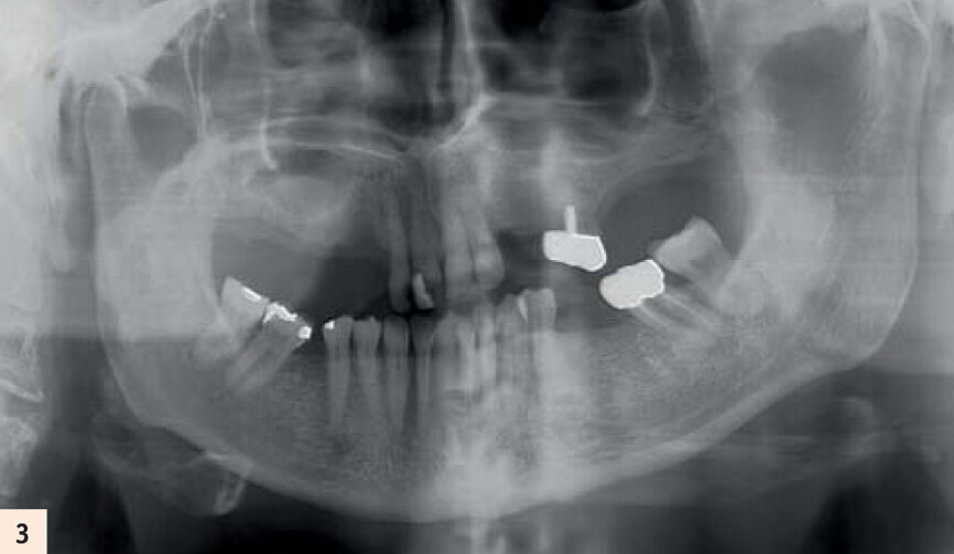Radiographie panoramique de la situation initiale. 