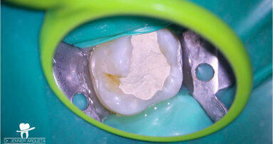 Vital pulp therapy—the clinical perspective