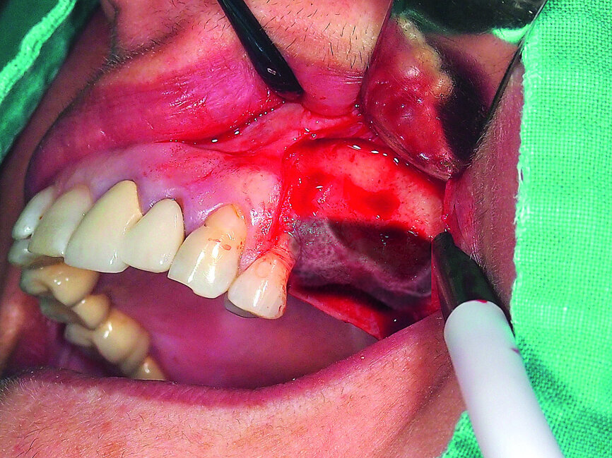 Fig. 4: Superimposing the pneumatised sinus floor CBCT scan over the surgical area.