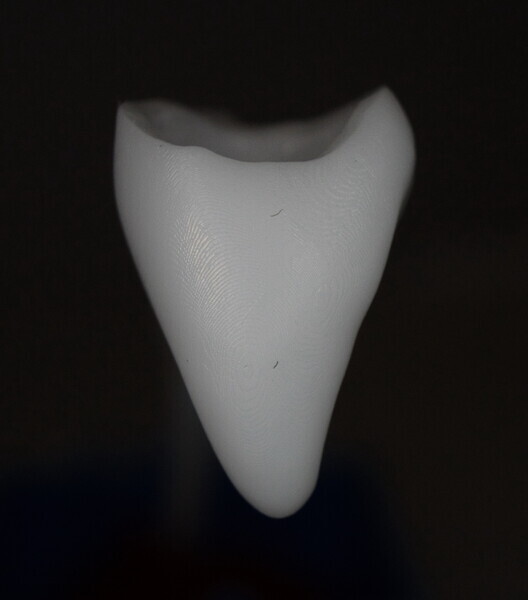 Fig. 10: 3D-printed crown for tooth #11, proximal view.