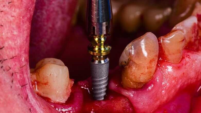 Membrána potažená nanočásticemi stříbra může zlepšit implantologické ošetření