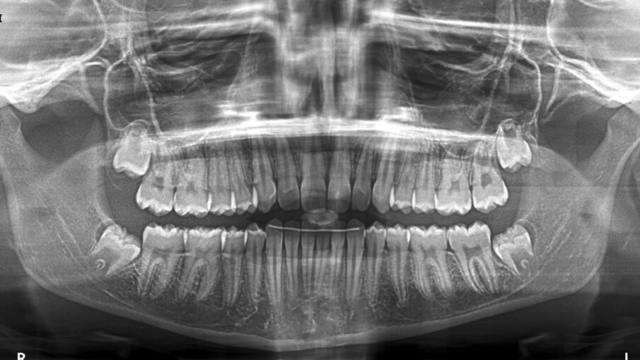 Fig. 24_Ortopantomografia post-trattamento.