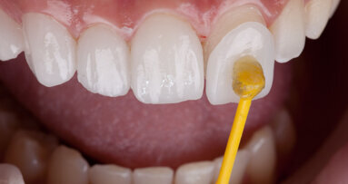 Researchers suggest their 3D-printed veneers are the future